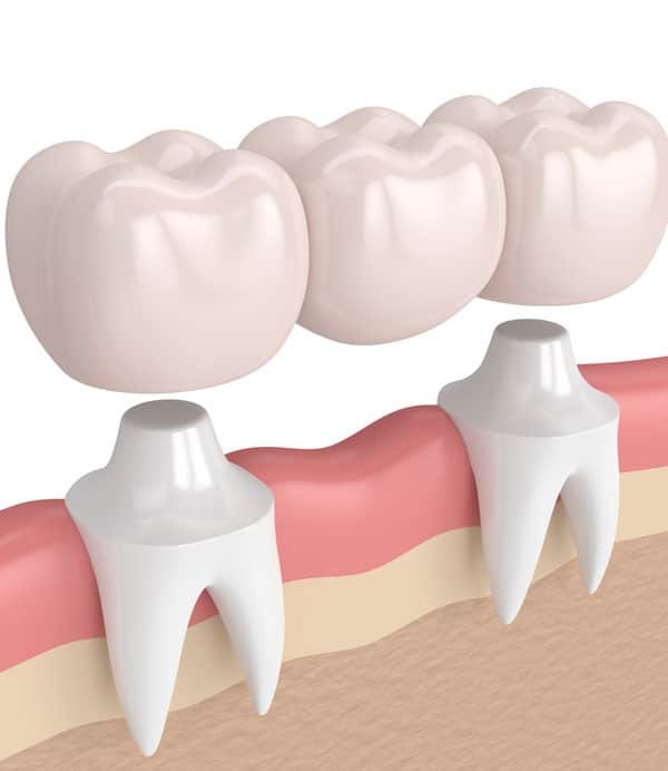 img-What-Is-The-Procedure-Of-Placing-A-Crown